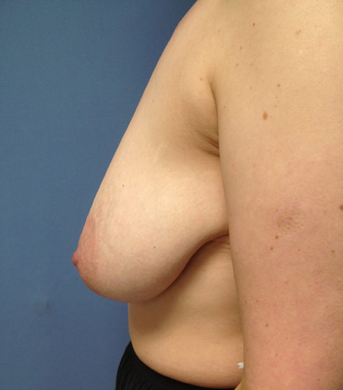 Breast Reduction