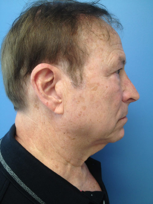 Male Facelift