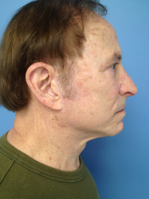 Male Facelift Case 646 After Photo Male Facelift