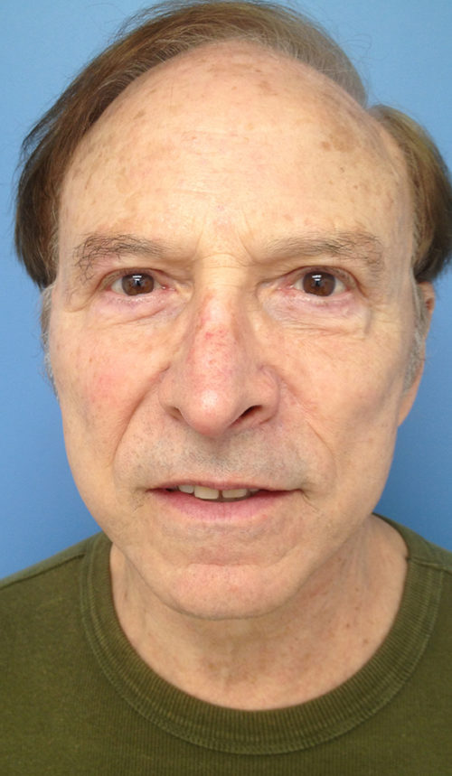 Male Facelift Case 646 After Photo Male Facelift