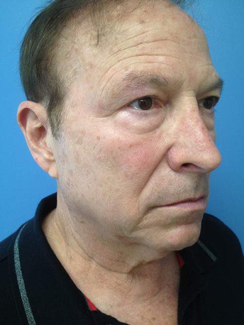Male Facelift Case 646 Before Photo Male Facelift