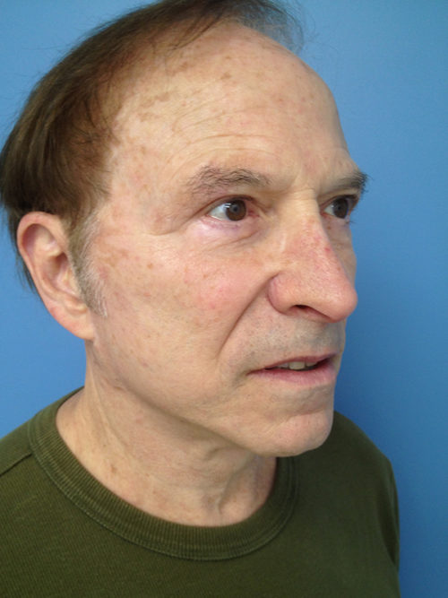 Male Facelift Case 646 After Photo Male Facelift