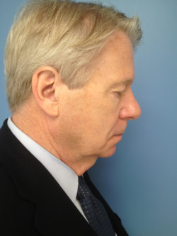 Male Facelift