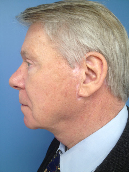 Male Facelift Case 647 After Photo Male Facelift