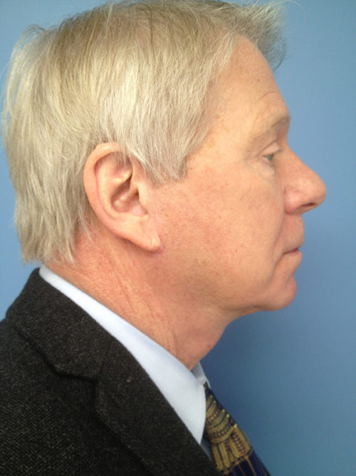 Male Facelift Case 647 After Photo Male Facelift