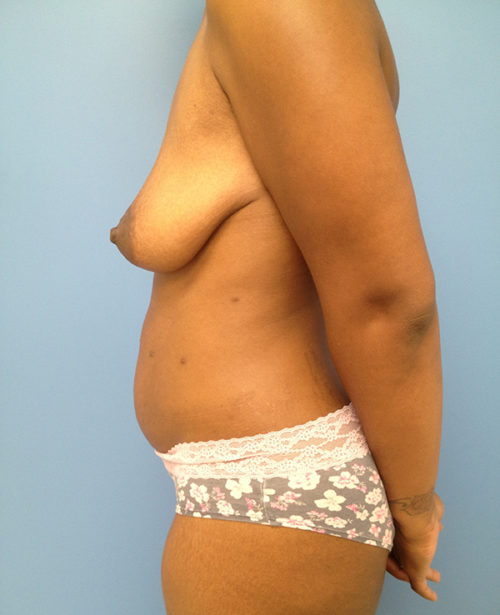Mommy Makeover Case 681 Before Photo Mommy Makeover