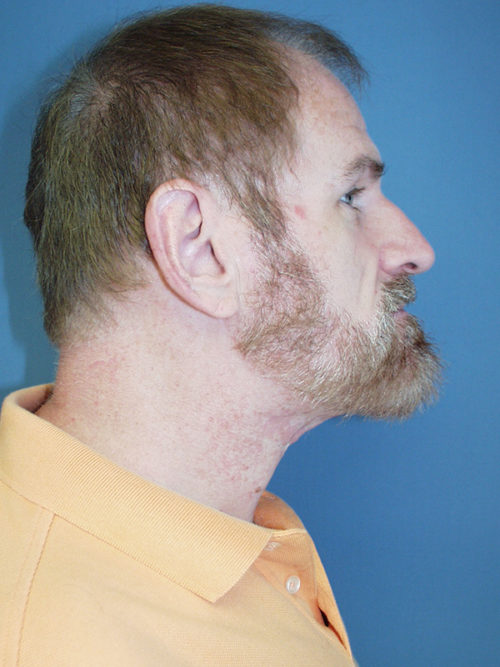 Direct Excision Neck Lift