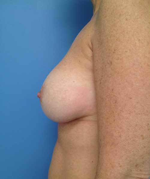 Other Breast Procedures