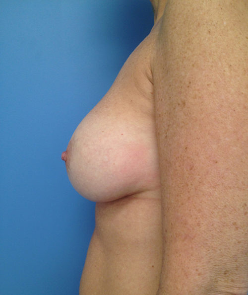 Other Breast Procedures Case 730 After Photo Other Breast Procedures
