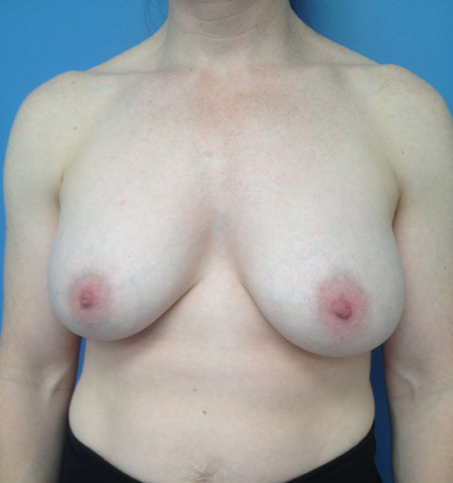 Other Breast Procedures Case 731 Before Photo Other Breast Procedures