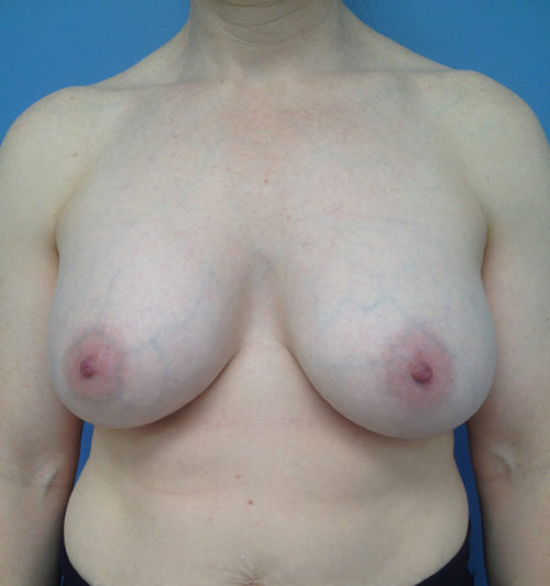 Other Breast Procedures Case 731 After Photo Other Breast Procedures