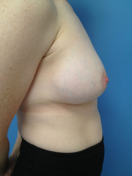 Other Breast Procedures Case 731 Before Photo Other Breast Procedures