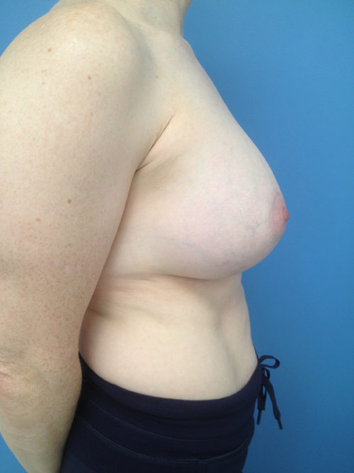 Other Breast Procedures Case 731 After Photo Other Breast Procedures