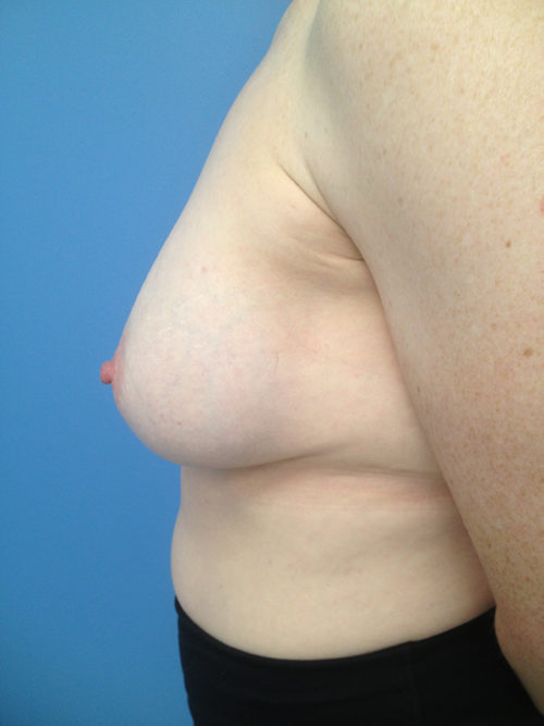 Other Breast Procedures Case 731 Before Photo Other Breast Procedures