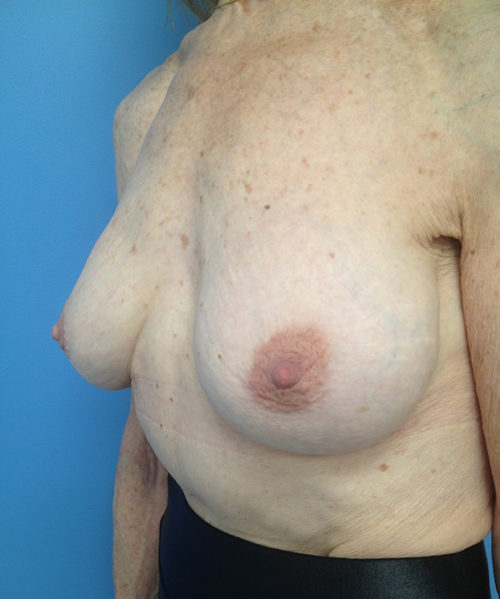 Other Breast Procedures Case 732 After Photo Other Breast Procedures