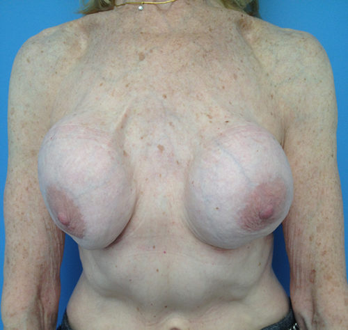 Other Breast Procedures Case 732 Before Photo Other Breast Procedures