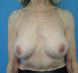 Other Breast Procedures