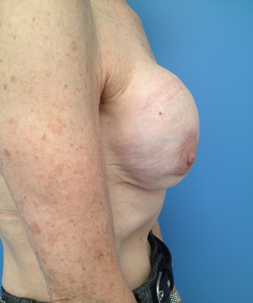Other Breast Procedures Case 732 Before Photo Other Breast Procedures