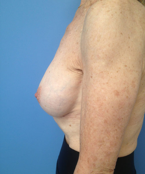 Other Breast Procedures Case 732 After Photo Other Breast Procedures