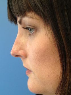 Other Nasal Procedures