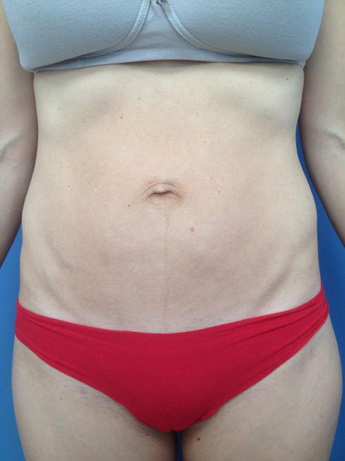 Tummy Tuck (Abdominoplasty) Case 300 Before Photo Tummy Tuck (Abdominoplasty)