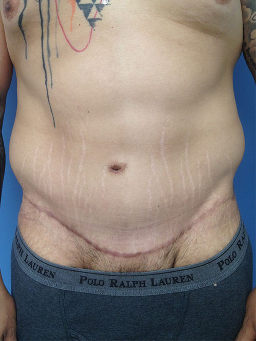 Male Abdominoplasty/Body Lift Case 406 After Photo Male Abdominoplasty/Body Lift