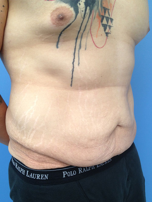 Male Abdominoplasty/Body Lift