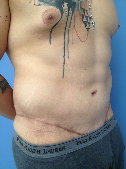 Male Abdominoplasty/Body Lift