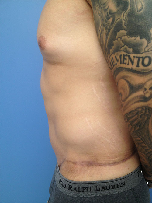 Male Abdominoplasty/Body Lift