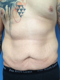 Male Abdominoplasty/Body Lift