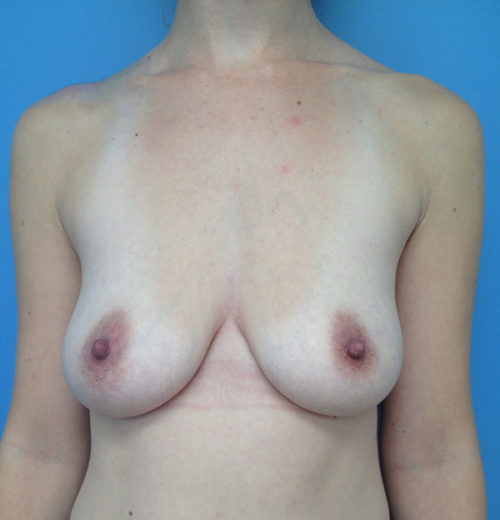 Breast Augmentation Case 769 Before Photo Breast Augmentation