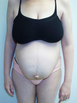 Tummy Tuck (Abdominoplasty)