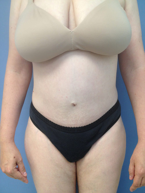 Tummy Tuck (Abdominoplasty)