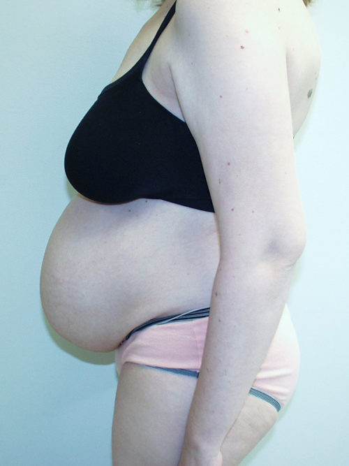 Tummy Tuck (Abdominoplasty) Case 816 Before Photo Tummy Tuck (Abdominoplasty)
