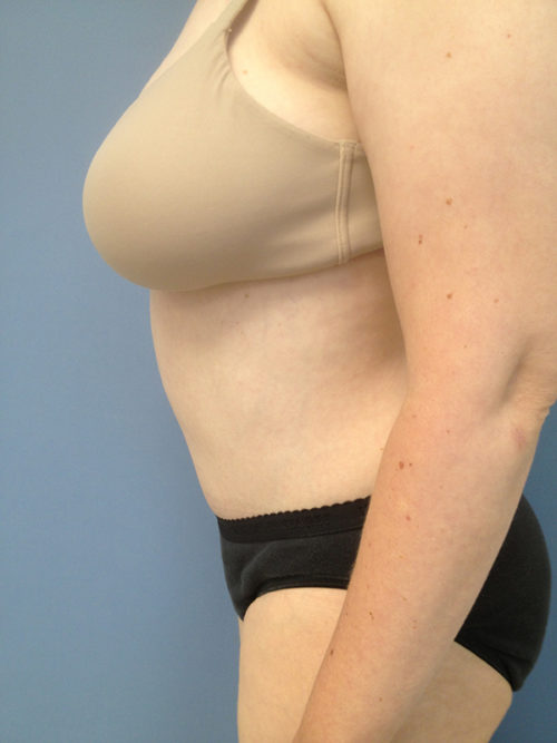 Tummy Tuck (Abdominoplasty)