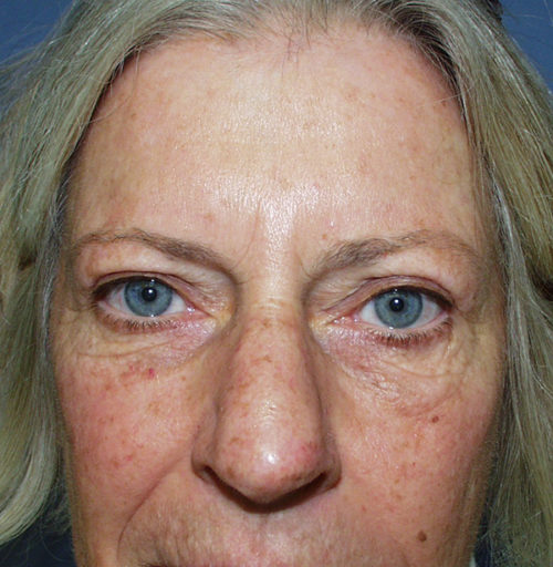 Eyelid Surgery