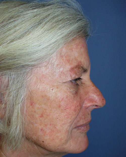 Eyelid Surgery Case 845 Before Photo Eyelid Surgery