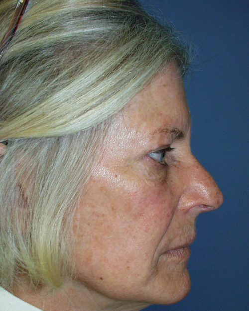 Eyelid Surgery Case 845 After Photo Eyelid Surgery