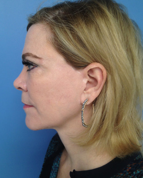 Face & Neck Lift Case 853 After Photo Face & Neck Lift