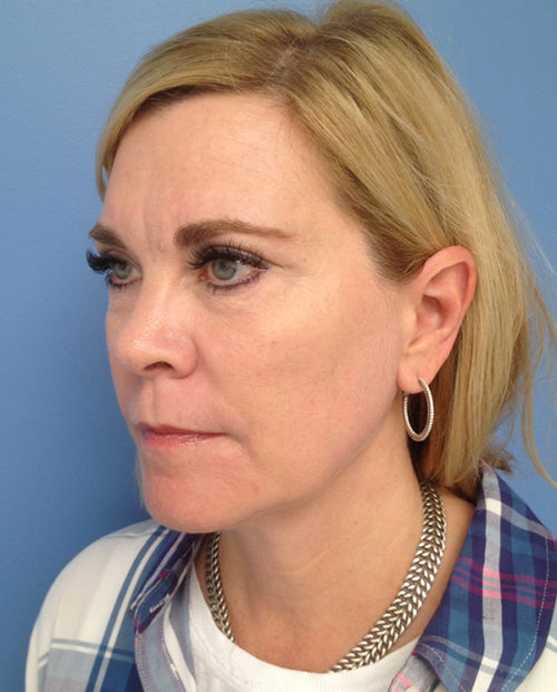 Face & Neck Lift Case 853 Before Photo Face & Neck Lift