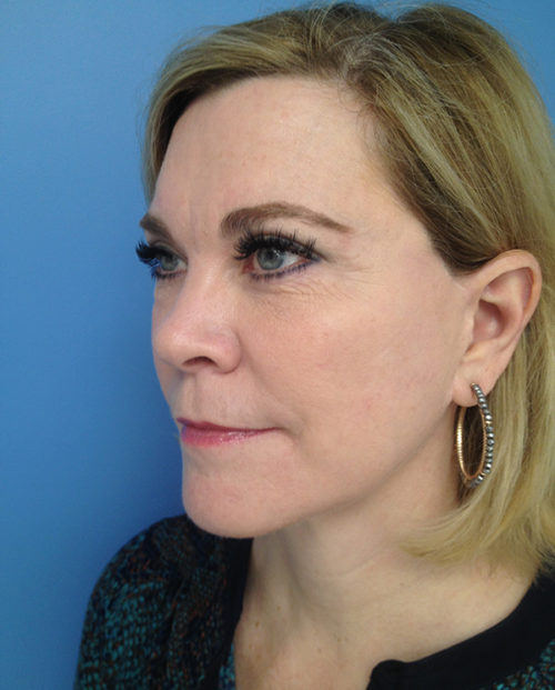 Face & Neck Lift Case 853 After Photo Face & Neck Lift