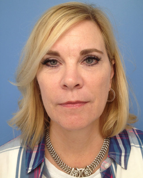 Face & Neck Lift Case 853 Before Photo Face & Neck Lift