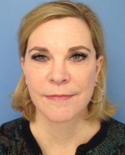 Facelift Results Washington DC