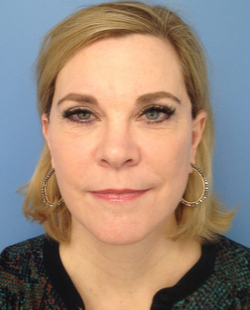 Face & Neck Lift Case 853 After Photo Face & Neck Lift