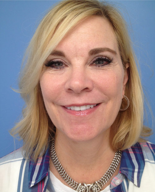 Face & Neck Lift Case 853 Before Photo Face & Neck Lift