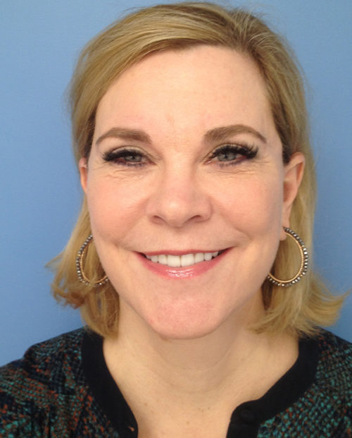 Face & Neck Lift Case 853 After Photo Face & Neck Lift