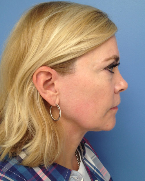 Face & Neck Lift Case 853 Before Photo Face & Neck Lift