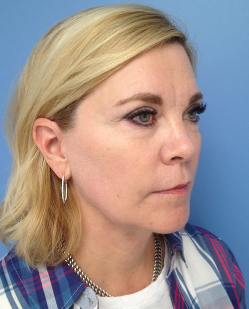 Face & Neck Lift Case 853 Before Photo Face & Neck Lift