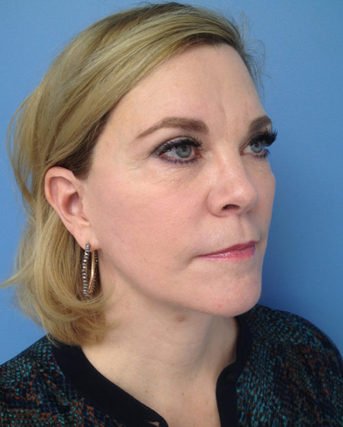 Face & Neck Lift Case 853 After Photo Face & Neck Lift