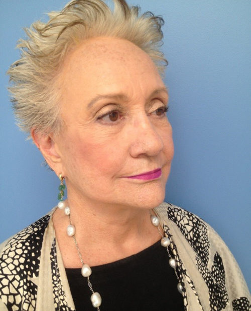 Face & Neck Lift Case 854 After Photo Face & Neck Lift